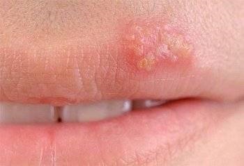 Care sunt cauzele herpesului pe față și cum să-l tratați