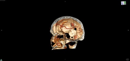 Consecințele trepanării craniului