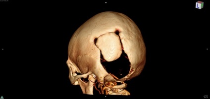 Consecințele trepanării craniului