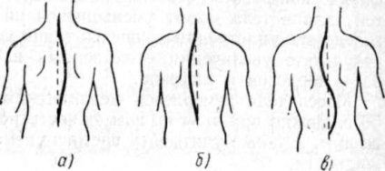 Jobb oldali scoliosis - Ignatiev klinikája