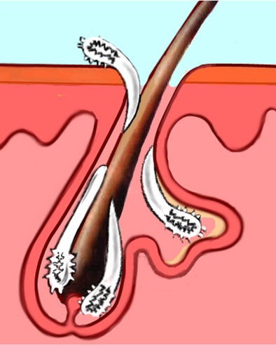 Drogurile delex acne de la instrucțiunile demodex și descriere