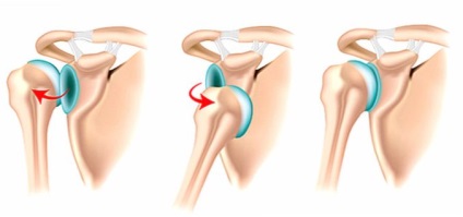 O dislocare obișnuită a umărului - cum se tratează și dacă este nevoie de o intervenție chirurgicală