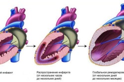 Semne de infarct miocardic la bărbați