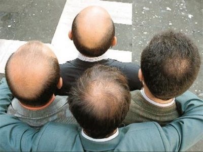 Simptomele alopeciei în alopecia androgenică, imbricate și difuze sunt simptome de înfrângere