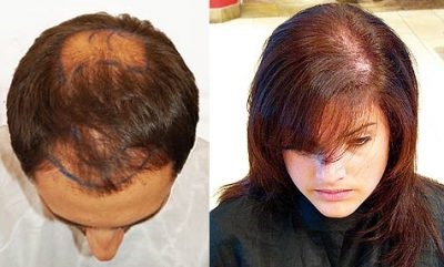 Simptomele alopeciei în alopecia androgenică, imbricate și difuze sunt simptome de înfrângere