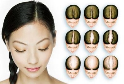 Simptomele alopeciei în alopecia androgenică, imbricate și difuze sunt simptome de înfrângere