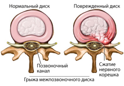 Probleme de spate și revizuirea leziunilor subiectului - portal medical eurolab