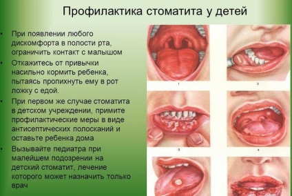 Stomatitis megelőzése felnőtteknél, gyermekeknél és csecsemőknél egy évig