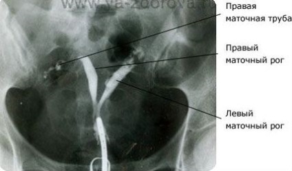 Trecerea trompelor uterine - blogul meu beteshka