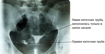 Trecerea trompelor uterine - blogul meu beteshka