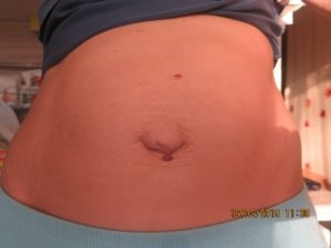 Herniile ombilicale după naștere, de ce apare și cum se tratează