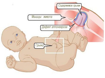 O hernie ombilicală la nou-născut