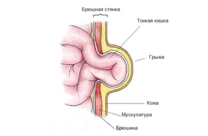 O hernie ombilicală la nou-născut