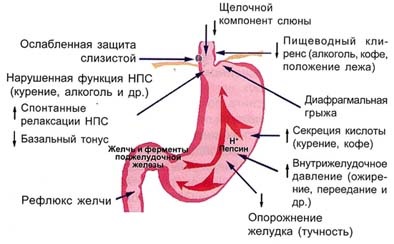 Esofagită de reflux - specii, stadii de esofagită de reflux, cauze ale bolii