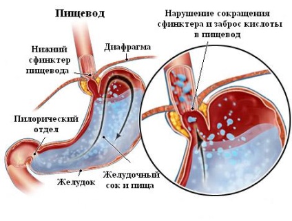 Esofagită de reflux - specii, stadii de esofagită de reflux, cauze ale bolii