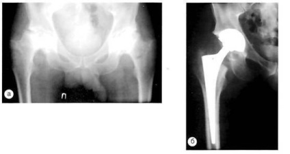 Evaluarea radiografică a artroplastiei primare a șoldului