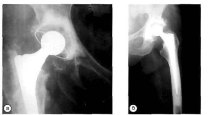 Evaluarea radiografică a artroplastiei primare a șoldului