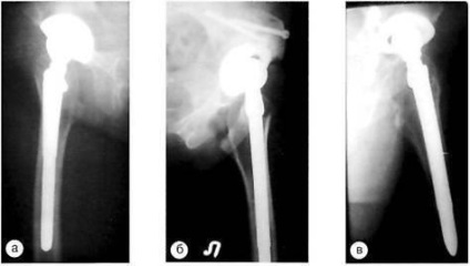 Evaluarea radiografică a artroplastiei primare a șoldului