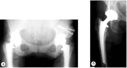 Evaluarea radiografică a artroplastiei primare a șoldului