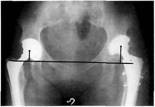 Рентгенологічна оцінка первинної артропластики кульшового суглоба