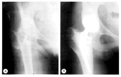 Evaluarea radiografică a artroplastiei primare a șoldului