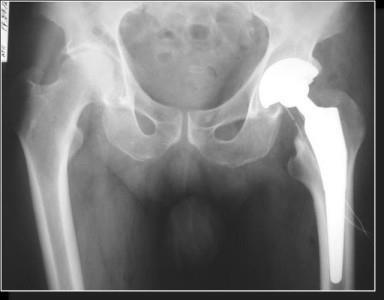 A csípő röntgensugara az osteoarthritis endoprotetikája után