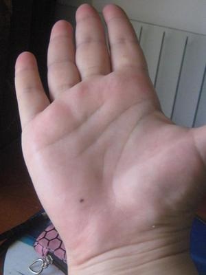 Semnul de naștere pe palma dreptului său și modul în care tratează palmistry