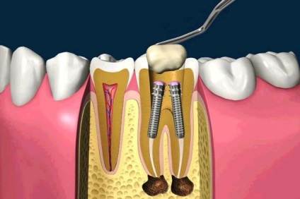Pini de instalare, materiale, tipuri, este dureros de a pune un PIN dentar