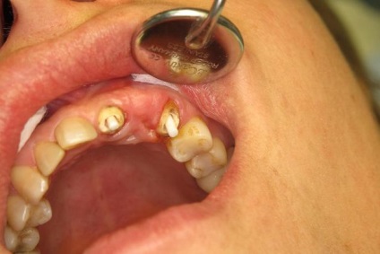Incentive scout Specific Pini de instalare, materiale, tipuri, este dureros de a pune un PIN dentar