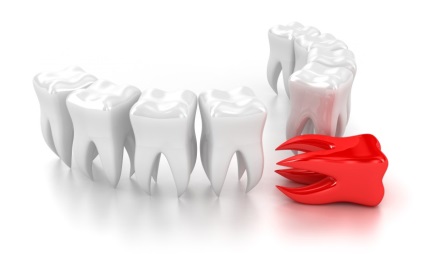 Tipuri puternice de durere de dinți, cauze și mecanisme de dezvoltare