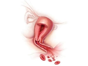 Simptomele rupturii ovariene la femei