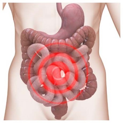 Sindromul intestinului iritabil (SCC) - Baza de cunoștințe - Clubul de sănătate