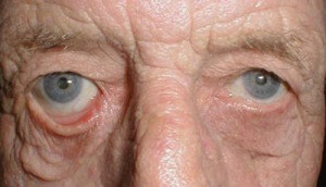 Lachrimarea ochilor