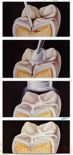 Plăci dentare moderne; închidere ușoară - instalare; pentru a pune un sigiliu ușor pe dinții din față