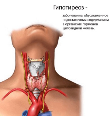 Stenocardia codului de tensiune cu μB-10