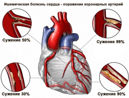 Stenocardia codului de tensiune cu μB-10