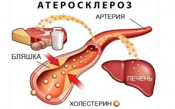 Stenocardia codului de tensiune cu μB-10