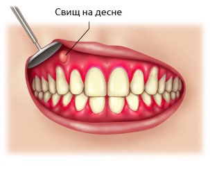 Fistula pe gingiile unui copil și în timpul tratamentului la sarcină la domiciliu