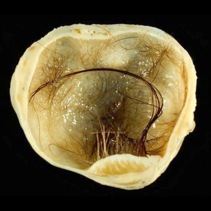 Teratomul ovarului, testiculului, gâtului și regiunii sacrococciciale la copii fotografie, cauze, tratament