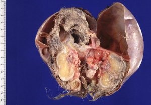 Teratomul ovarului, testiculului, gâtului și regiunii sacrococciciale la copii fotografie, cauze, tratament