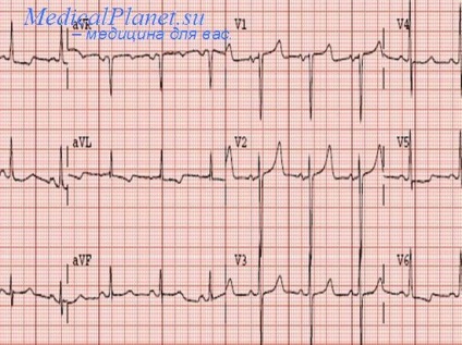 Infarct miocardic transmural