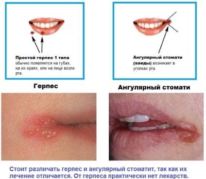 Fisuri în colțurile buzelor cauze și tratament, prevenire