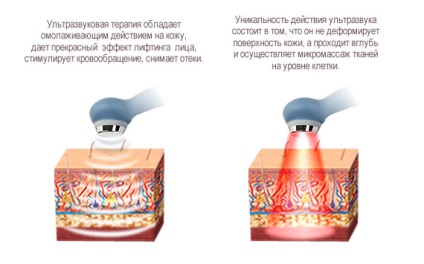 Terapia facială cu ultrasunete 1