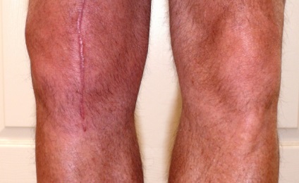 Îngrijirea înfundării după înlocuirea protezei genunchiului