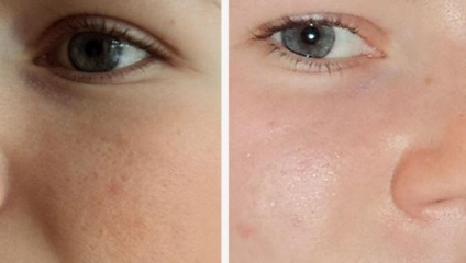 Curățarea prin aspirație a pielii feței - care sunt avantajele și dezavantajele