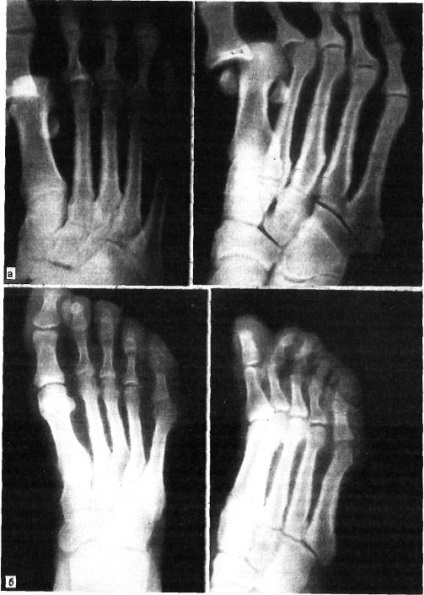 Dislocarea degetului, simptome, semne, diagnostic și tratament