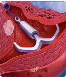 Intrauterin spirál, egészségügyi folyóirat