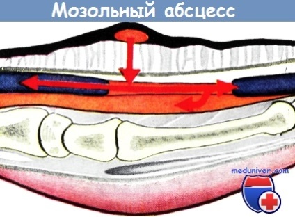 Inflamația calusului mâinii (abcesul corneei) - diagnostic, tratament