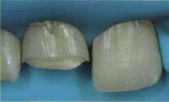 Recrearea unui model optic tridimensional al țesuturilor dentare, dentar-siberian