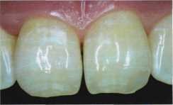 Recrearea unui model optic tridimensional al țesuturilor dentare, dentar-siberian